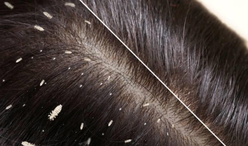 Odisha News:Tragedy-in-Puri-12-Year-Old-Succumbs-to-Severe-Scalp-Infection