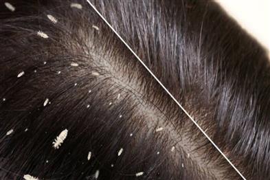 Odisha News:Tragedy-in-Puri-12-Year-Old-Succumbs-to-Severe-Scalp-Infection
